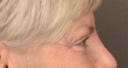 Blepharoplasty Before & After Patient #3468