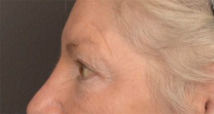Blepharoplasty Before & After Patient #3468