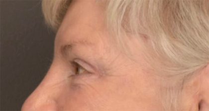 Blepharoplasty Before & After Patient #3468