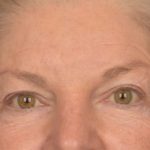 Brow Lift Before & After Patient #3469