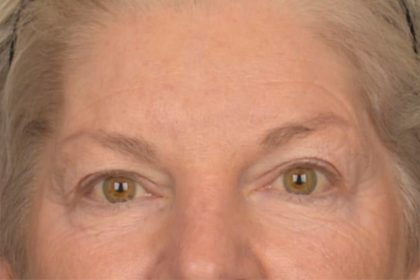Brow Lift Before & After Patient #3469