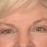 Brow Lift Before & After Patient #3469