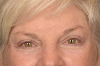 Brow Lift Before & After Patient #3469