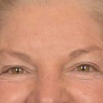 Brow Lift Before & After Patient #3469
