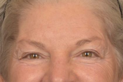 Brow Lift Before & After Patient #3469