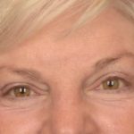 Brow Lift Before & After Patient #3469