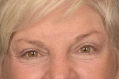 Brow Lift Before & After Patient #3469