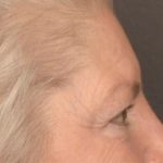 Brow Lift Before & After Patient #3469