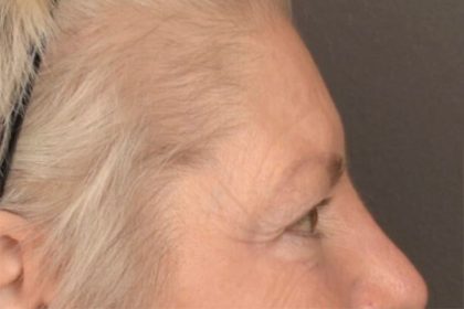 Brow Lift Before & After Patient #3469