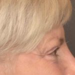 Brow Lift Before & After Patient #3469