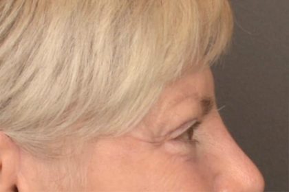 Brow Lift Before & After Patient #3469