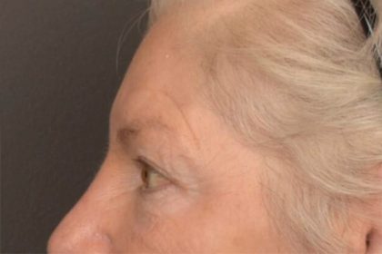 Brow Lift Before & After Patient #3469