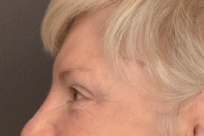 Brow Lift Before & After Patient #3469