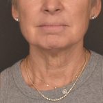 Neck Lift Before & After Patient #3471