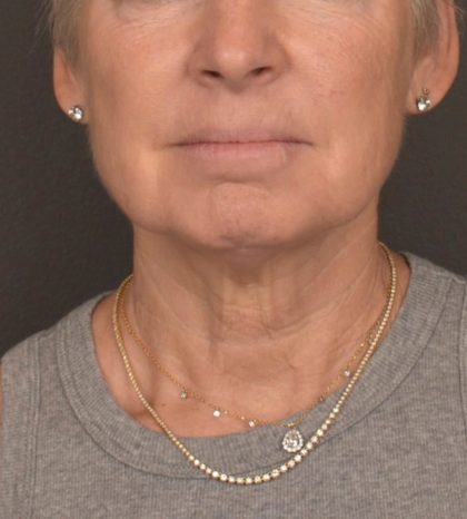 Neck Lift Before & After Patient #3471