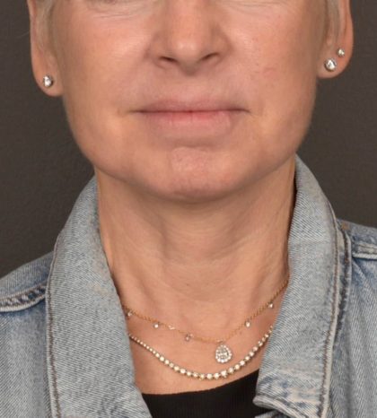 Neck Lift Before & After Patient #3471