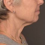 Neck Lift Before & After Patient #3471