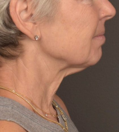 Neck Lift Before & After Patient #3471