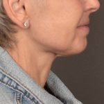 Neck Lift Before & After Patient #3471