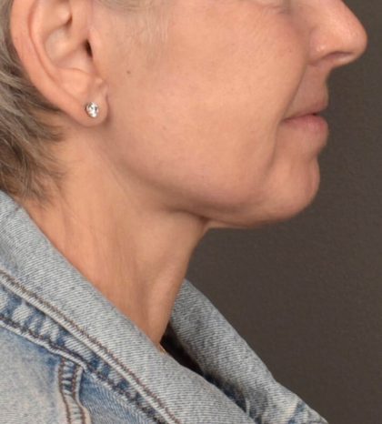 Neck Lift Before & After Patient #3471