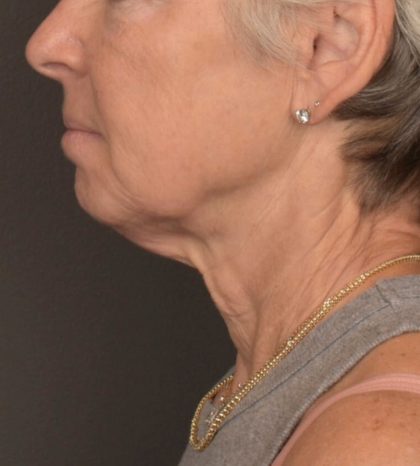 Neck Lift Before & After Patient #3471