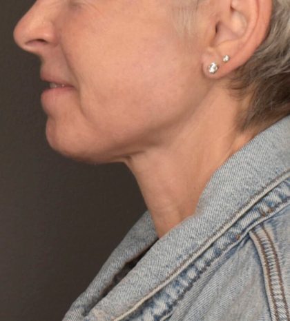 Neck Lift Before & After Patient #3471