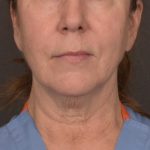 Neck Lift Before & After Patient #3915
