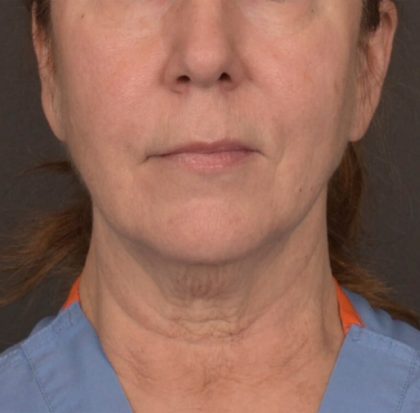 Neck Lift Before & After Patient #3915