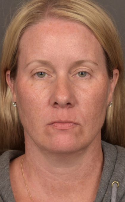 Facelift Before & After Patient #4014