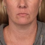 Neck Lift Before & After Patient #4015