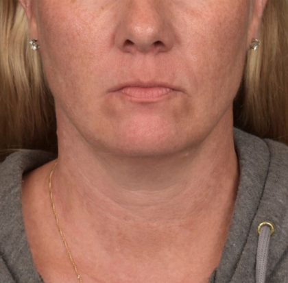 Neck Lift Before & After Patient #4015