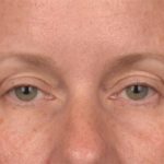 Blepharoplasty Before & After Patient #4016