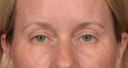 Blepharoplasty Before & After Patient #4016