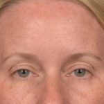 Brow Lift Before & After Patient #4017