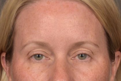 Brow Lift Before & After Patient #4017