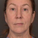 Facelift Before & After Patient #3914