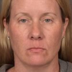 Facial Fat Grafting Before & After Patient #4018