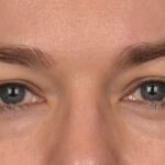 Blepharoplasty Before & After Patient #4059