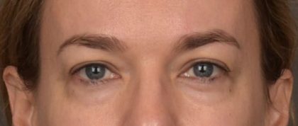 Blepharoplasty Before & After Patient #4059