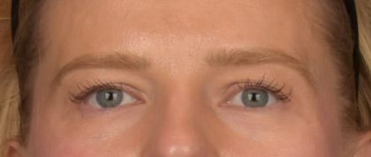 Blepharoplasty Before & After Patient #4074