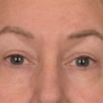 Blepharoplasty Before & After Patient #3916