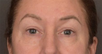 Blepharoplasty Before & After Patient #3916