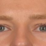Brow Lift Before & After Patient #4075
