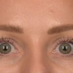 Brow Lift Before & After Patient #4095