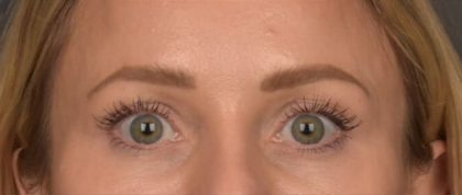 Brow Lift Before & After Patient #4095