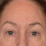 Brow Lift Before & After Patient #3917