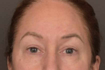 Brow Lift Before & After Patient #3917