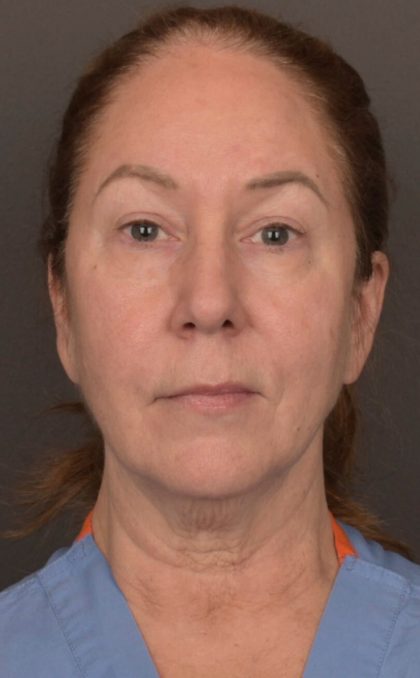Facial Fat Grafting Before & After Patient #3918