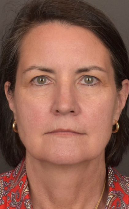 Facelift Before & After Patient #3961