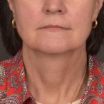Neck Lift Before & After Patient #3962